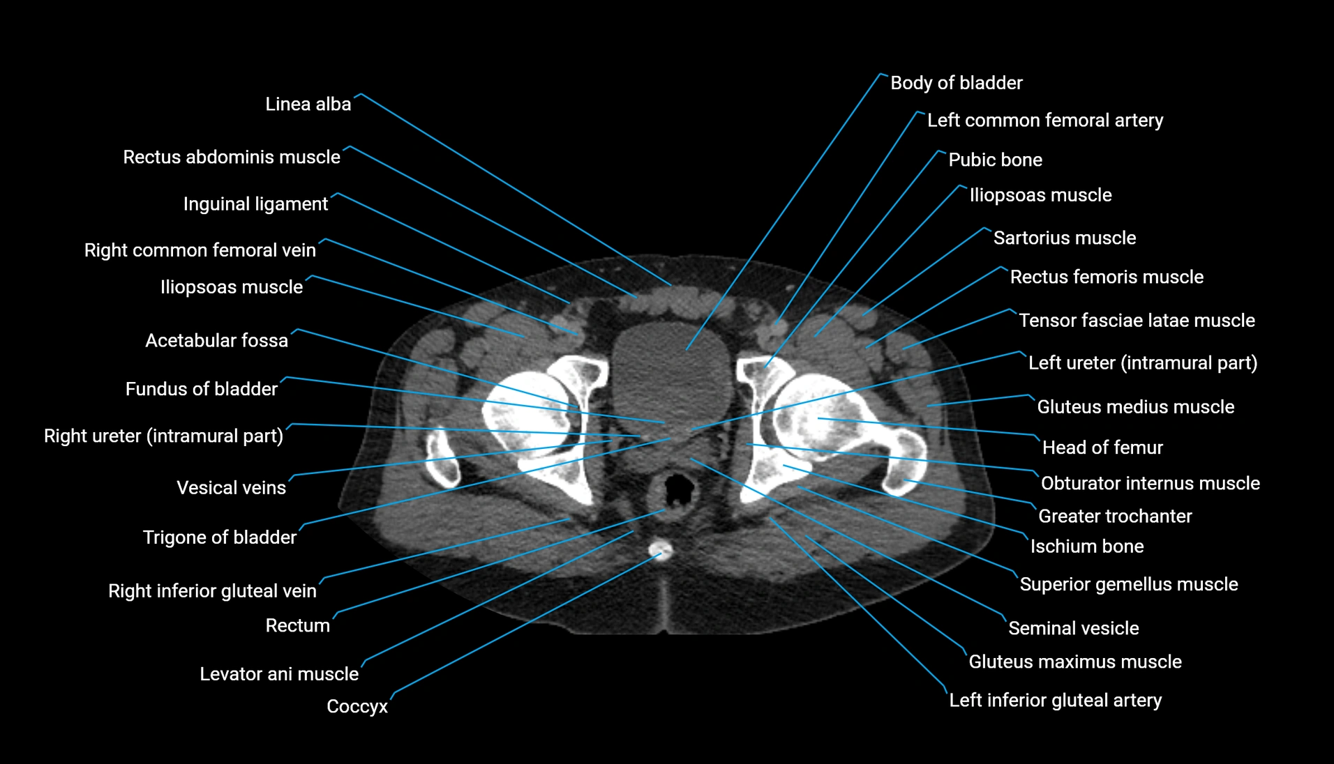 CT urogram axial cross sectional anatomy  labelled radiology image-00236.webp